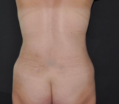 Flank, Back, and Waist Liposuction